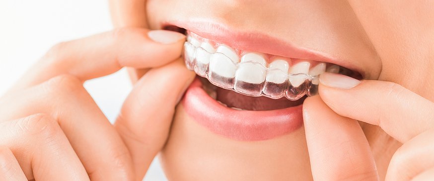 Invisalign treatment